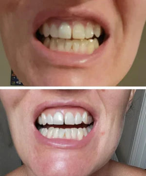 HZA Purple Teeth Whitening Strips