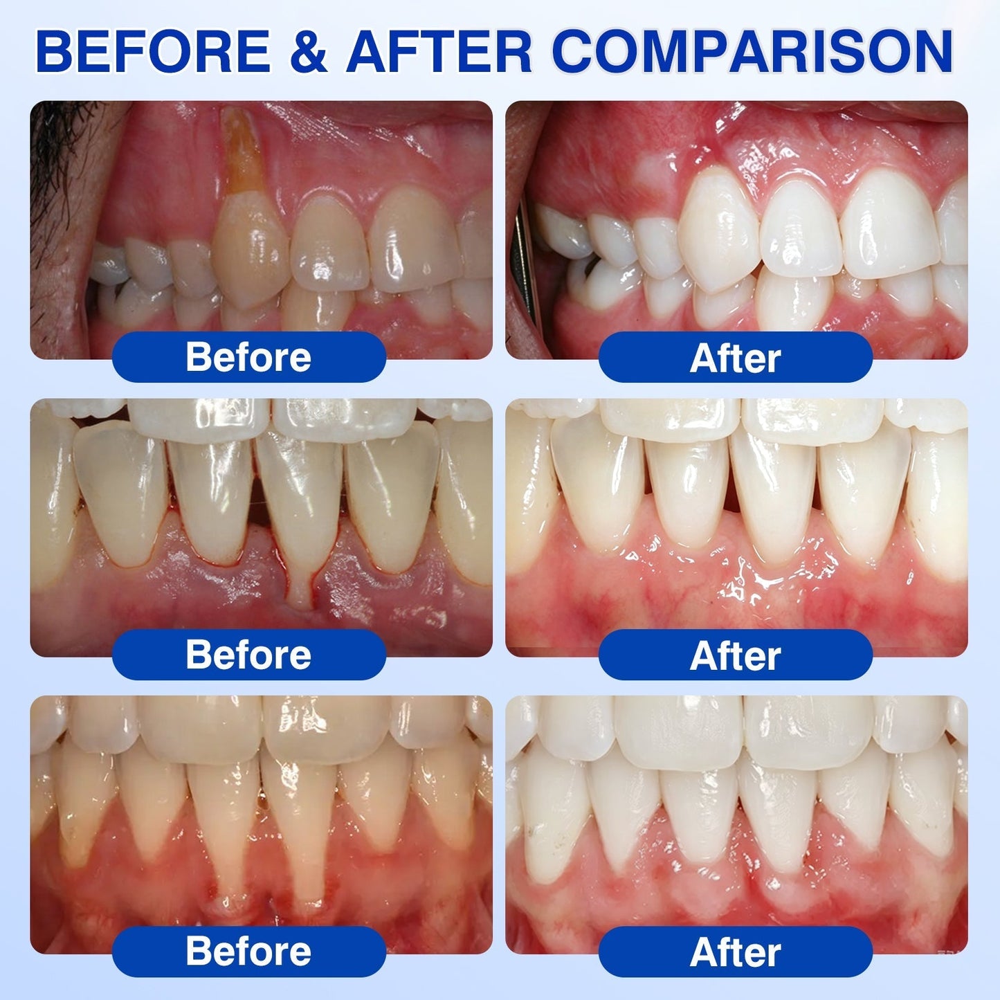 👨‍⚕️Haugde® GumRevive Periodontal Repair Gel🦷🛡️